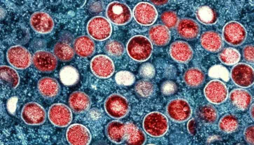 First Known Case of Severe Mpox Strain Confirmed in California, US